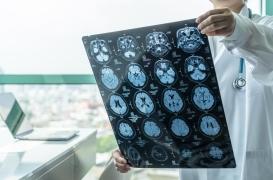 Constamment assoiffée, une femme apprend qu’elle a un cancer du cerveau