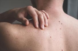 Cancer de la peau : comment l’IA détecte très tôt les risques