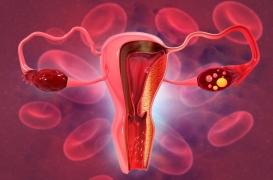 Journée mondiale du cancer de l'ovaire : 