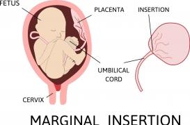 Le stupéfiant pouvoir du cordon ombilical contre la Covid-19