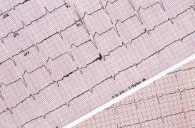 Prise en charge de la fibrillation atriale : les recommandations de la Société Européenne de Cardiologie