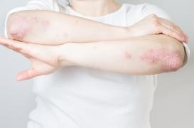 Maladie cœliaque : le psoriasis accroît les risques 