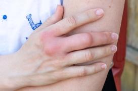 Attaque d’abeilles : comment traiter une piqûre ?