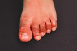 Orteils Covid : possible signe d’une immunité naturelle