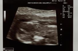 Un essai clinique permet à une femme de devenir mère après un cancer rare