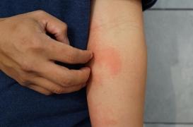 Eczéma : comment faire pour se gratter moins souvent ?