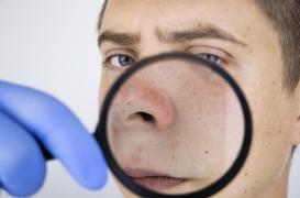 Lupus : une nouvelle cible thérapeutique découverte