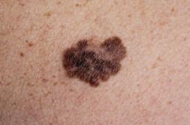 Sa tache de naissance était en fait un cancer de la peau