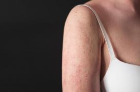 Le psoriasis impacte durement la vie sexuelle des malades