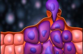 Cancer : une technique pour «endormir» les tumeurs