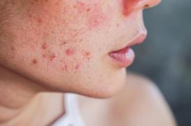 Acné : les dermatologues émettent de nouvelles recommandations pour la prescription d’Isotrétinoïne (Roaccutane)