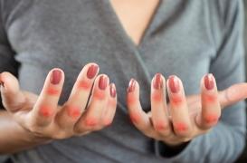 Lupus : qu'est-ce qui peut déclencher la maladie ? 