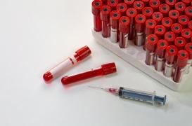 Covid long : des chercheurs ont découvert des biomarqueurs