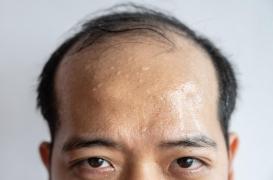 La sueur, un marqueur de l’état de santé ? 