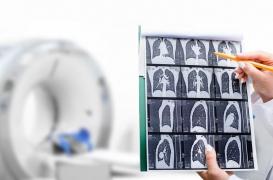 Cancer du poumon : pourquoi il faut aller plus loin dans le dépistage