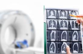 Cancer du poumon : l’importance du dépistage précoce pour réduire les décès