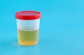 Cancer de la vessie : ce simple test pourrait évaluer le risque de récidive 