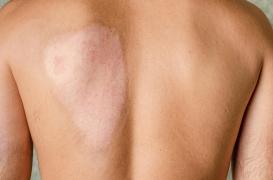 Maladies cutanées rares : les greffes de peau génétiquement saine seraient prometteuses