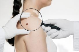 Mélanome : les 4 cas où l'aspect d'un grain de beauté doit vous alerter 