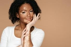 Vitiligo : plus de risque de dépression chez les patients ?