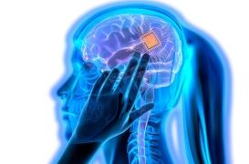 TOC : un implant cérébral soigne une femme de 34 ans 