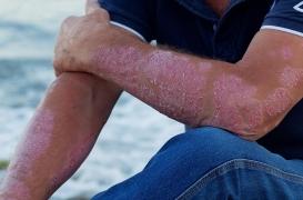 Psoriasis : près de deux tiers des patients angoissent durant l’été 
