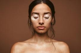 Vitiligo : un traitement qui repigmente la peau autorisé et remboursé en France