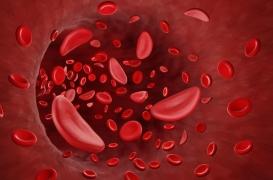 La drépanocytose, un enjeu de santé publique en France