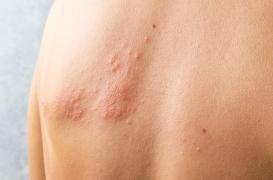 Zona : un risque potentiel d'Alzheimer ? 