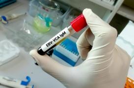 Bientôt un nouveau vaccin contre le virus d'Epstein-Barr ?