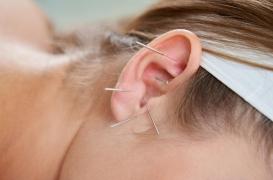 Perte de poids : l’acupuncture auriculaire serait efficace chez les hommes 