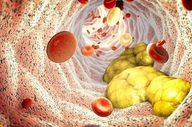 Maladie coronarienne : une variante du mauvaise cholestérol augmente les risques 