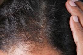 Beyoncé annonce être atteinte de psoriasis depuis l’enfance