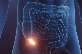 Pourquoi les cancers de l'appendice explosent chez les jeunes