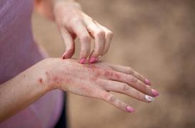 Psoriasis : certains lipides pourraient exacerber les douleurs
