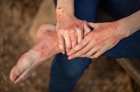 Psoriasis : la pollution de l'air peut favoriser son apparition