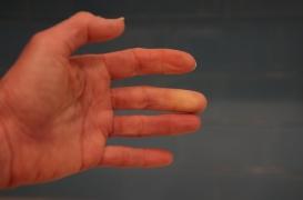 Vous avez les mains froides ? Ce test d'une minute vous dira si vous souffrez du syndrome de Raynaud