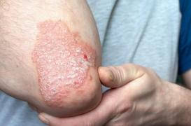 Psoriasis : « le chemin reste encore long pour en finir avec les idées reçues »
