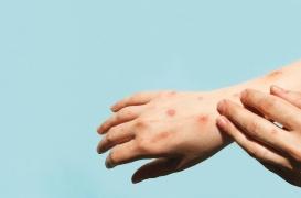 Vaccin MPox : on peut désormais le faire dans toutes les pharmacies 