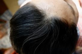 Chute de cheveux chez les femmes de 50 ans : principales causes et solutions 