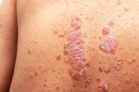 Psoriasis : l’incidence de la maladie va grimper jusqu’en 2050