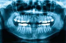 L'apnée du sommeil serait liée à des os et des dents plus faibles chez l’adulte