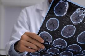 Traumatisme crânien : des implants cérébraux ont aidé 5 personnes à se rétablir