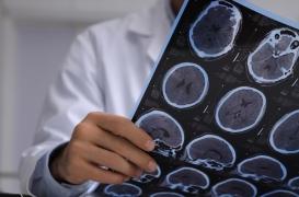 Un lien entre lésions cérébrales et le suicide, selon une étude