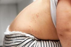 Rougeole : 25 nouveaux cas dans le Rhône