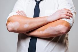 Vitiligo : « J’ai été traité de chimpanzé par mon ex-conjointe »