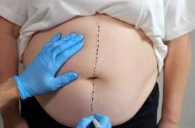 Chirurgie bariatrique : l'IA aide les médecins à prédire la perte de poids
