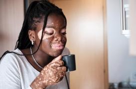 Ce médicament contre le vitiligo est disponible dans toutes les pharmacies