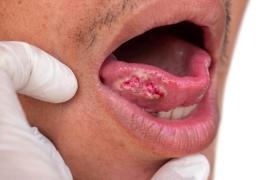 Cancer de la bouche : siroter même un seul verre de cette boisson par jour accroît le risque