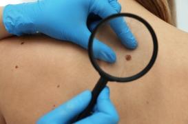 Mélanomes, carcinomes : “L’IA n’a pas vocation à remplacer le dermatologue, elle agit comme un assistant précieux”